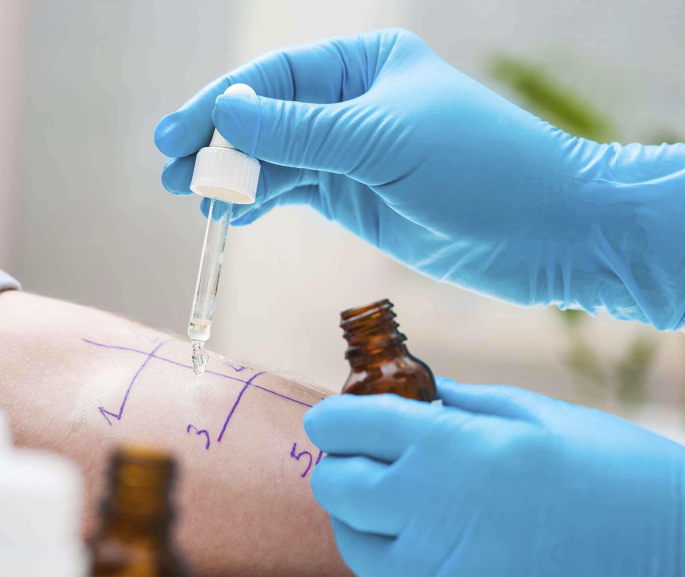 Allergietest auf dem Unterarm