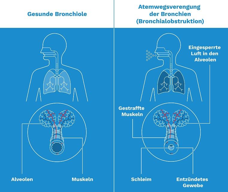 Symptome-Husten-Grafik