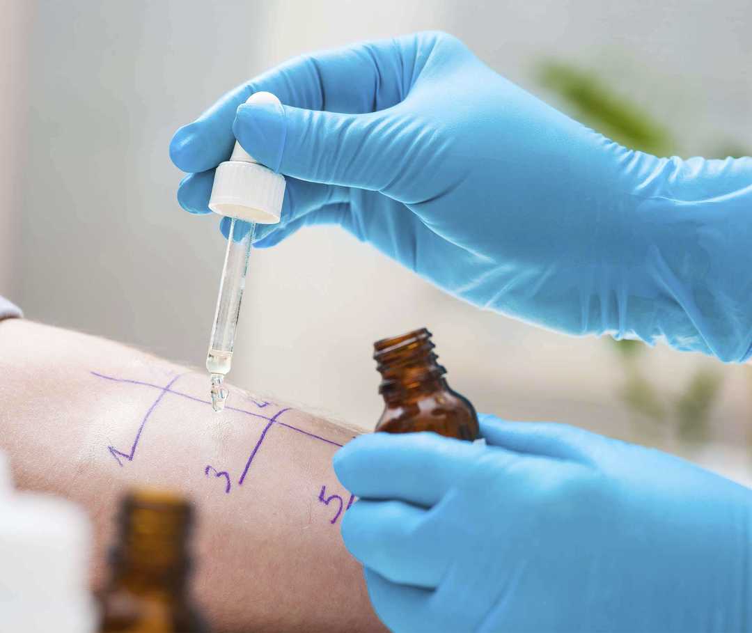 Allergietest auf dem Unterarm