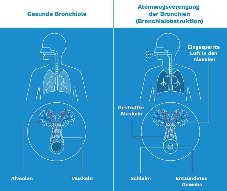 Grafik: Symptome bei Husten